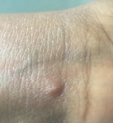 Mpox blister